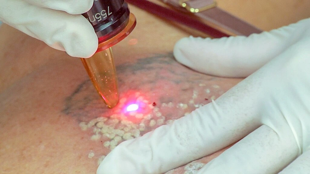 The Grown-Up Guide to Laser Treatments